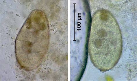 Human case of Fasciola gigantica-like infection, review of human ...