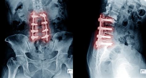 Spinal Fusion Surgery: why it might not fix your lower back pain - 2ser