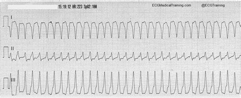 Wolff-Parkinson-White Syndrome - Part 2 - ECG Medical Training