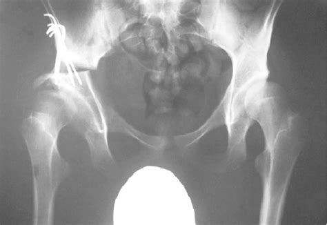 After Steel triple osteotomy, the right femoral head coverage was much ...