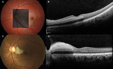 Comparison of isolated cilioretinal artery insufficiency (upper row) vs ...