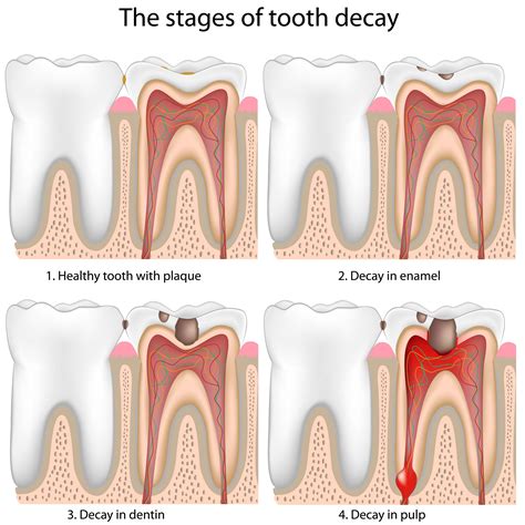 Stages of Tooth Decay - Lake Jackson, TX - Restorative Dentistry