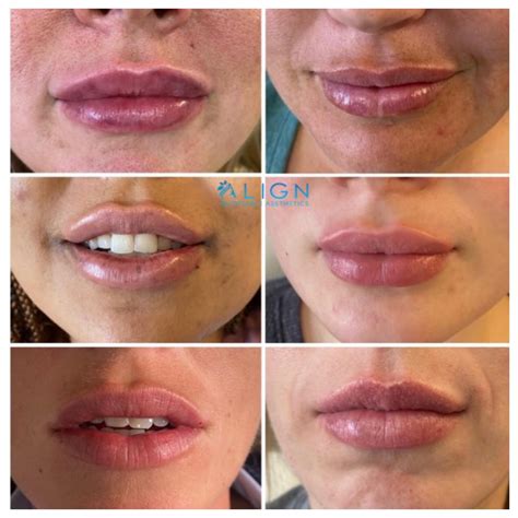 FAQ: Lip Injections | Align Injectable Aesthetics