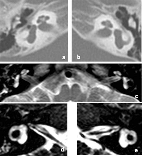 Fig.S6 -CT and MRI temporal bone, 3-D MR imagines. The bony labyrinth ...