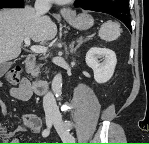 Multiple Accessory Spleens in Patient s/p Splenectomy - Spleen Case ...