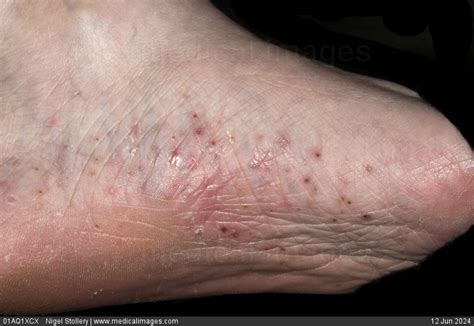 STOCK IMAGE, dermatology plantar pustular psoriasis multiple red and ...