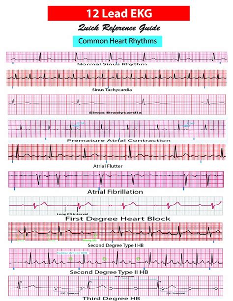 EKG Pocket Card | Ekg interpretation, Ekg, Ekg rhythms