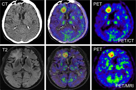 PET/CT and PET/MRI images of 56-y-old patient with glioblastoma ...