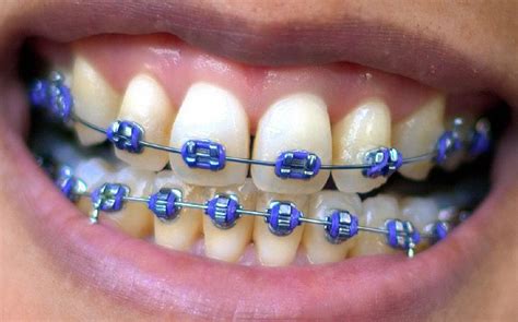 How Much Do Braces Cost in the UK? - The Dental Guide