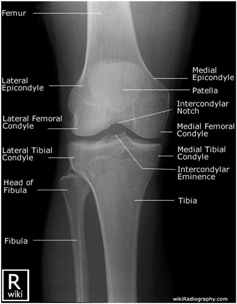 Adult Knee Radiographic Views - Trauma - Orthobullets