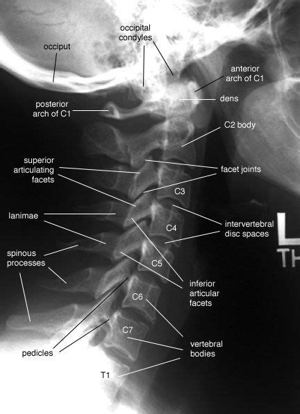 Radiographic Anatomy of the Skeleton: Cervical Spine -- Lateral View ...