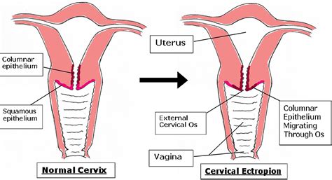 Cervical Ectropion - Causes, Symptoms & Cervical Ectropion Treatment