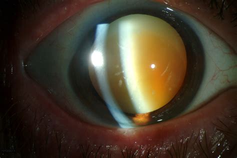 Hypermature Cataract: Meaning, Signs, Causes, Effects, Treatment