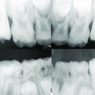 (PDF) Nonsyphilitic occurrence of mulberry molars: A rare case report