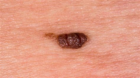 Home Remedies to Remove Genital Warts Safely