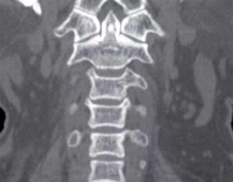 Cervical spine CT scan