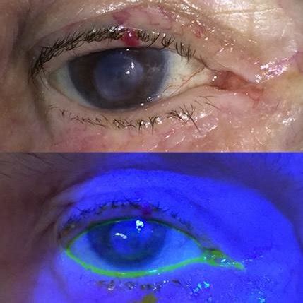 Central corneal scar 1yr post cataract surgery, no erosion | Download ...