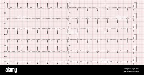 ECG example of a normal 12-lead sinus rhythm Stock Photo - Alamy