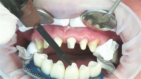 Procedure of Placing Dental Veneers (Hollywood smile) - YouTube