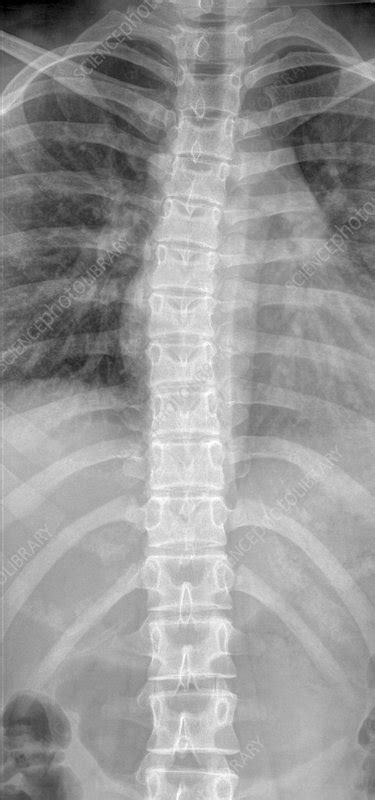 Normal spine and rib cage, X-ray - Stock Image C002/3273 - Science ...