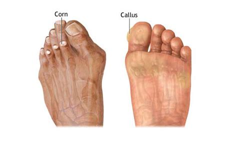 Corn and Callus - Causes Presentation and Treatment | Bone and Spine