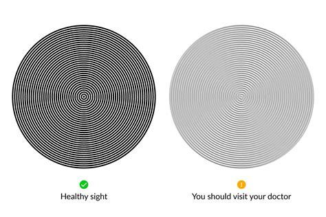 Astigmatism | eyerim blog