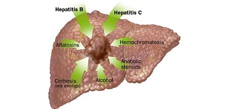 Liver Pain : Location , Causes , Symptoms And Treatment