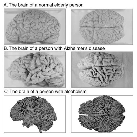 This Is Your Brain On Alcohol - Rehab Guide