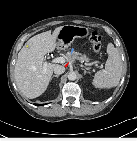 Ct Scan Abdomen Pelvis Anatomy