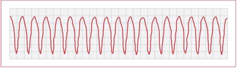 Ekg Practice Strips Printable With Answers - Tutore.org