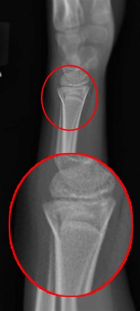 Torus fracture definition, causes, diagnosis & torus fracture treatment