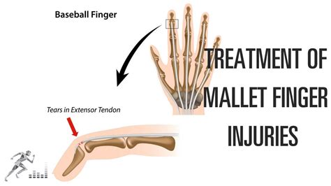 What Causes Mallet Finger Injury at Heidi Appel blog