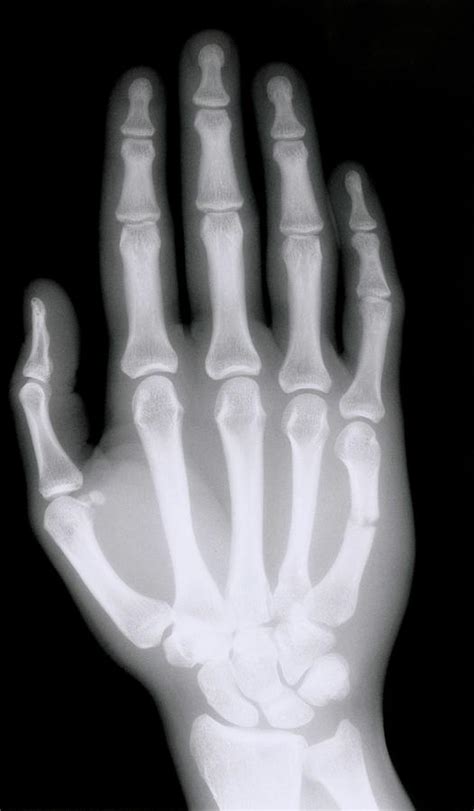 X-ray Of Broken Bone In Right Hand Photograph by Science Photo Library ...