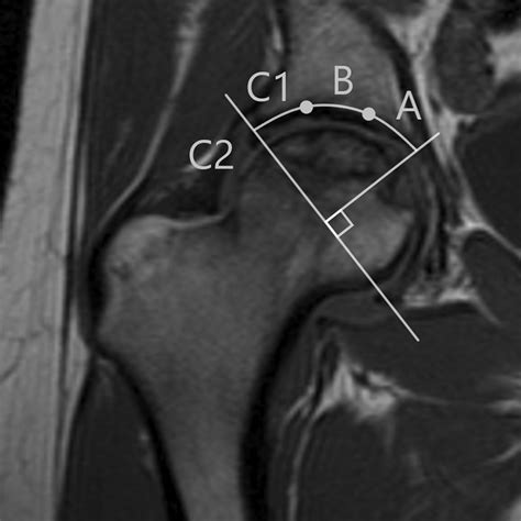 Magnetic Resonance Imaging Of Avascular Necrosis Of The, 51% OFF