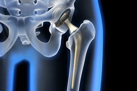 DePuy Hip Implants - Kane & Silverman P.C. in Philadelphia and NJ