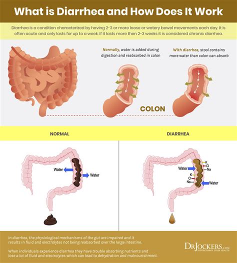 Diarrhea