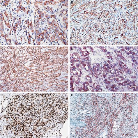 Immunohistochemical Endothelial Markers: A Review : Advances in ...