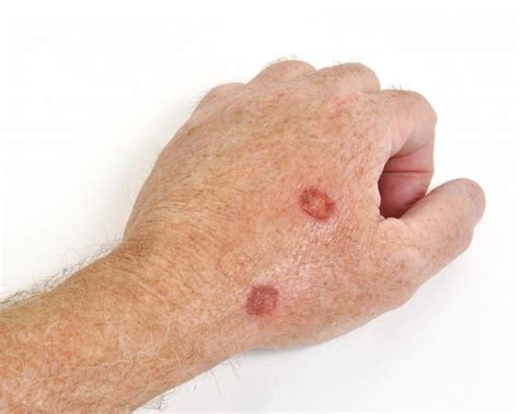 What Causes an Itchy Scab? (with pictures)