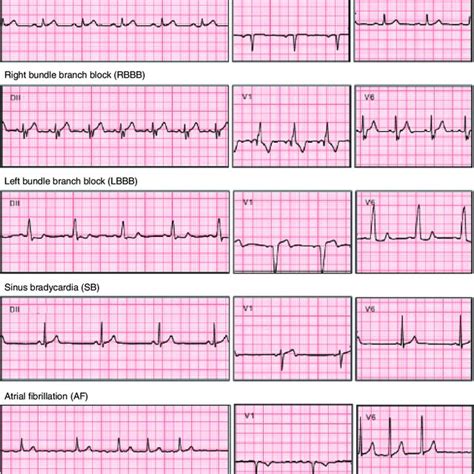 Different Types Of Abnormal Ekg