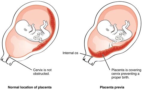 What is placenta previa? - AskDrManny