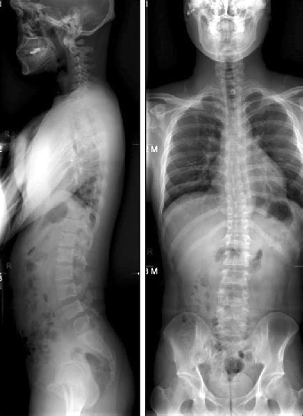 What Does A Normal Lumbar Spine X Ray Look Like - Design Talk