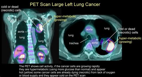 Xrays and CT Scans of Lung Cancer