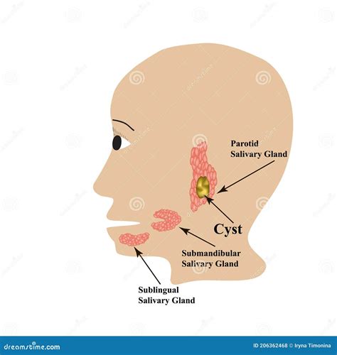 A Tumor On The Parotid Salivary Gland. Cartoon Vector | CartoonDealer ...