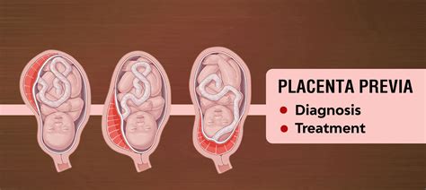 Placenta Previa: What Is It and What to Do? |MedplusMart