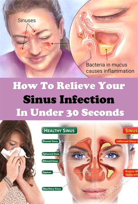 How To Relieve Your Sinus Infection In Under 30 Seconds | Home remedy ...