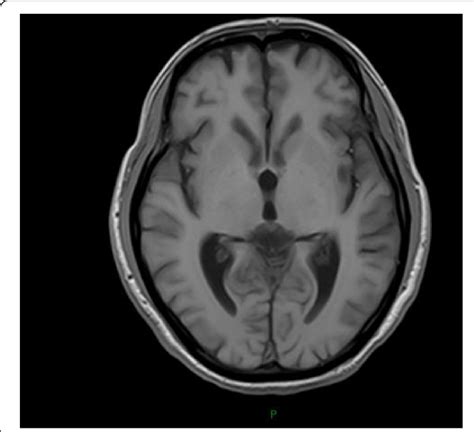 Enlarged Ventricles Brain Mri