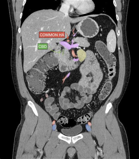 Normal Ct Scan Abdomen