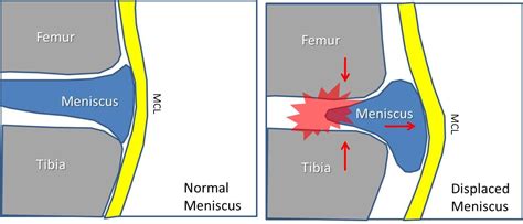 What Happens When Knee Meniscus Displaces From Surgery? The Outside of ...