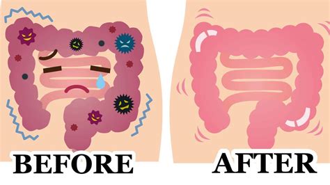 This 2 Ingredient Colon Cleanse Flushes POUNDS of Waste FAST