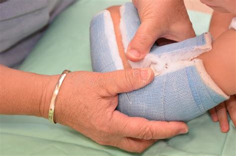 Cast removal stock image. Image of broken, medicine, insurance - 39386759